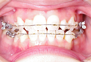 上下の歯を抜いてマルチブラケット装置にて上下顎歯列の排列を開始します。