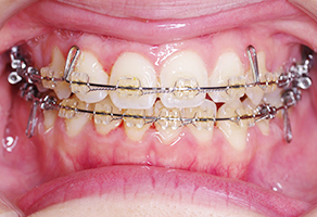 上下顎歯列のスペースを閉じて、上下顎歯列の咬み合わせの調整を行っています。