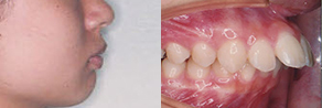 出っ歯(上顎前突) before