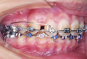 上顎前歯の圧下を進めています。