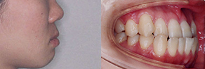 受け口(反対咬合) before
