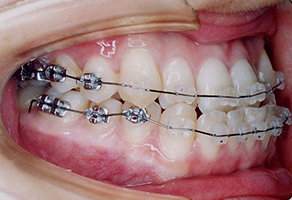 マルチブラケット法にて上下顎歯列の排列を開始します。