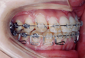 顎間ゴムを利用して、下顎の歯を遠心移動します。