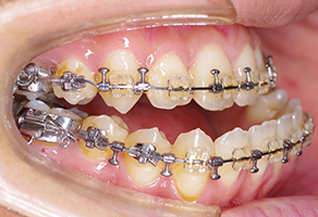 術前矯正治療が終了し、顎固定のためのフックをつけています。