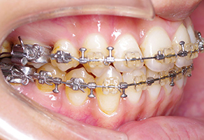 手術後、上下顎のバランスが良くなり、術後矯正治療は、上下顎歯列の噛み合わせの微調整を行います。